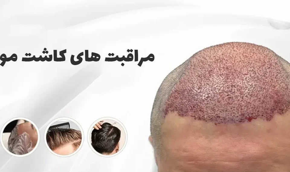 مراقبت‌های بعد از کاشت مو در تبریز؛ نکات طلایی