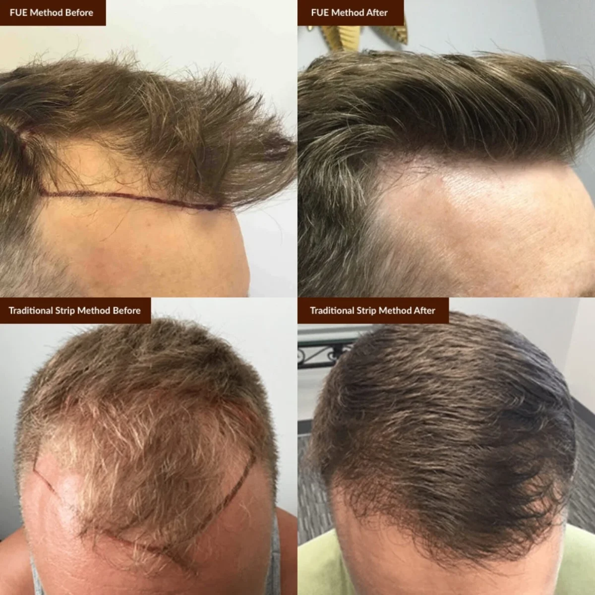 خط رویش طبیعی پس از کاشت مو