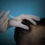 کاشت مو با تراکم بالا؛ آیا واقعاً ممکن است؟