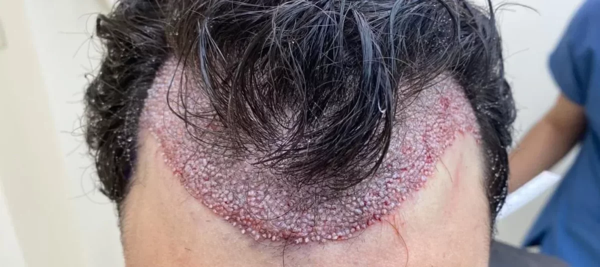 کاشت موی طبیعی در تبریز با جدیدترین روش‌های روز دنیا