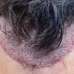 کاشت موی طبیعی در تبریز با جدیدترین روش‌های روز دنیا