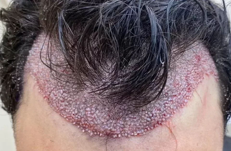 کاشت موی طبیعی در تبریز با جدیدترین روش‌های روز دنیا