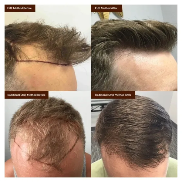 مراحل برداشت فولیکول با تکنیک FUE