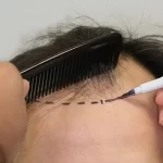 هزینه کاشت مو در تهران چقدر است؟