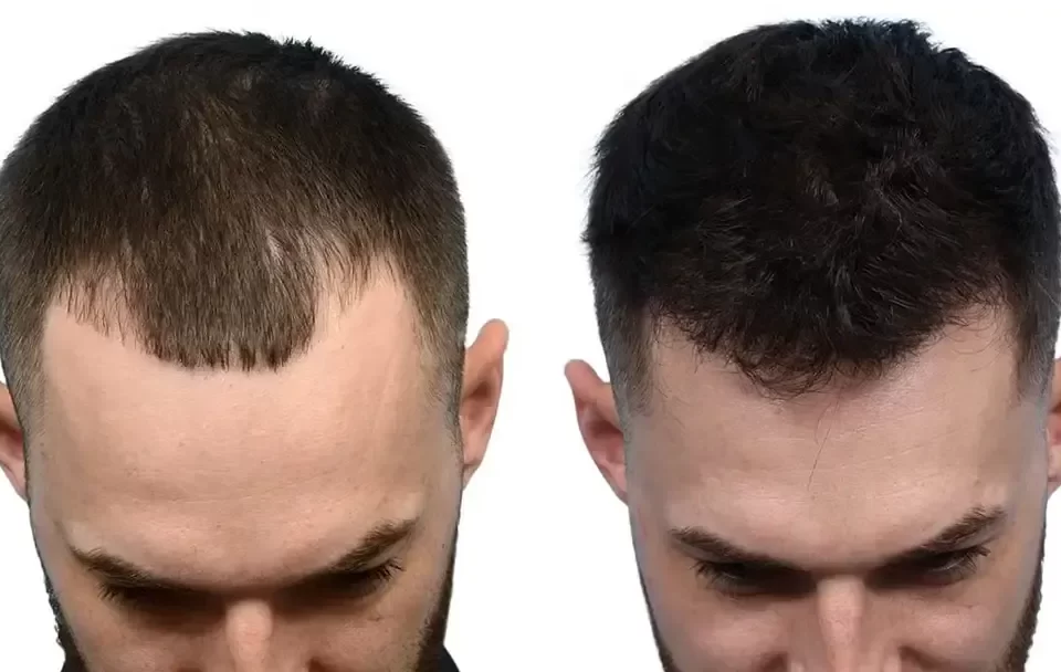 چرا کاشت مو در تبریز انتخاب هوشمندانه‌ای است؟