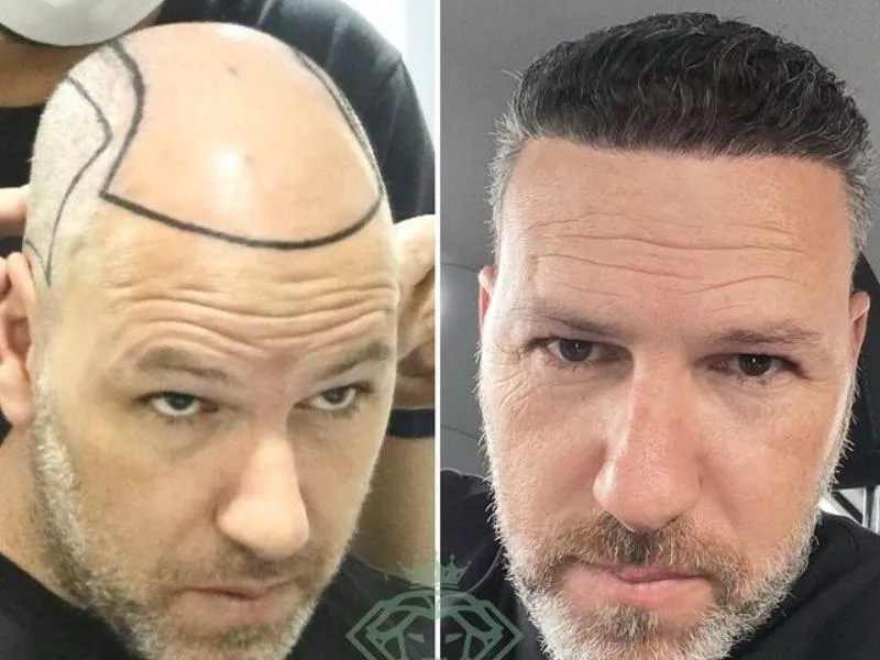 نمای نزدیک تارهای مو پس از کاشت در سر بیمار