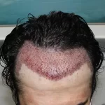 عوارض کاشت مو طبیعی و دائمی