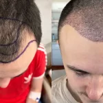 آیا کاشت مو در تبریز درد دارد؟ پاسخ علمی و تجربه بیماران