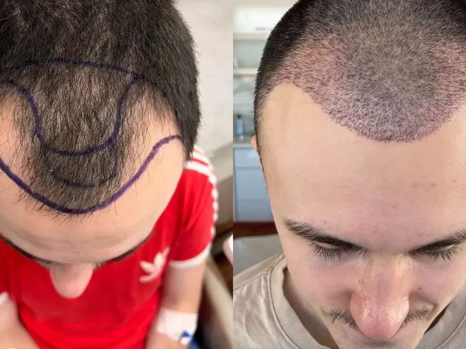 آیا کاشت مو در تبریز درد دارد؟ پاسخ علمی و تجربه بیماران