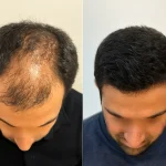 نتایج واقعی کاشت مو در تبریز؛ بررسی ماندگاری