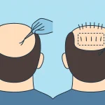 کاشت مو برای ریزش هورمونی؛ راهکاری قطعی برای بازگرداندن تراکم طبیعی