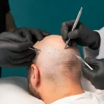 جدیدترین تکنیکهای کاشت مو در تبریز در سال ۲۰۲۵