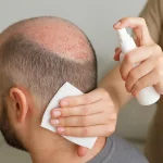 مراقبت‌های بعد از کاشت مو؛ نکات طلایی
