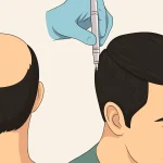 کاشت مو به روش SUT؛ مزایا و معایب