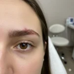کاشت ابرو برای جای زخم و اسکار