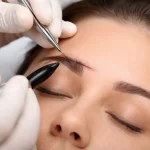 کاشت ابرو طبیعی برای جای بخیه؛ بازسازی مو در ناحیه اسکار