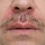 عوارض کاشت سبیل طبیعی؛ تحلیل علمی، پیشگیری و مدیریت حرفهای در سال ۲۰۲۵
