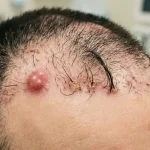 عوارض نادر کاشت مو (کیست، عفونت، رشد غیرطبیعی مو):تشخیص زودهنگام و پیشگیری