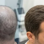 آیا کاشت مو باعث افزایش تراکم واقعی می‌شود؟ بررسی علمی تراکم مو پس از کاشت
